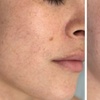 Image 8: Up to 55% Off on Facial - Chosen by Customer at Rise Skin Spa