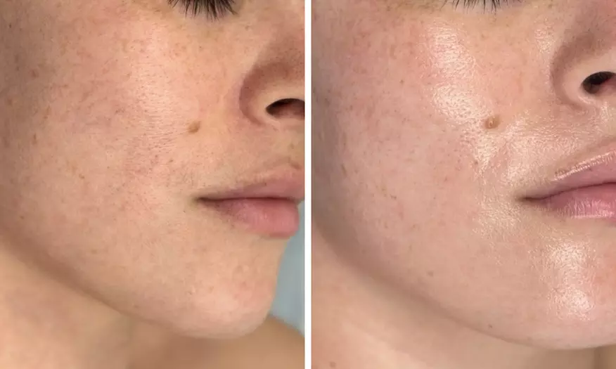 Up to 55% Off on Facial - Chosen by Customer at Rise Skin Spa