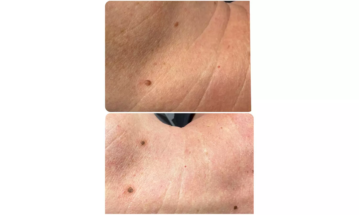 Plasma pen facial no quirúrgico para manchas y zona periocular