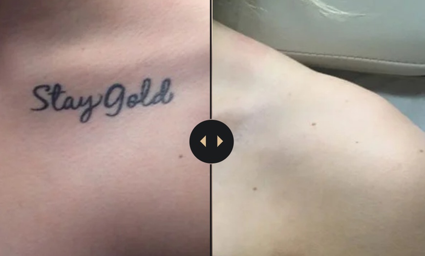 Image 2: Say Goodbye to Small Tattoos: 1 or 2 Removal Sessions on a Small Area