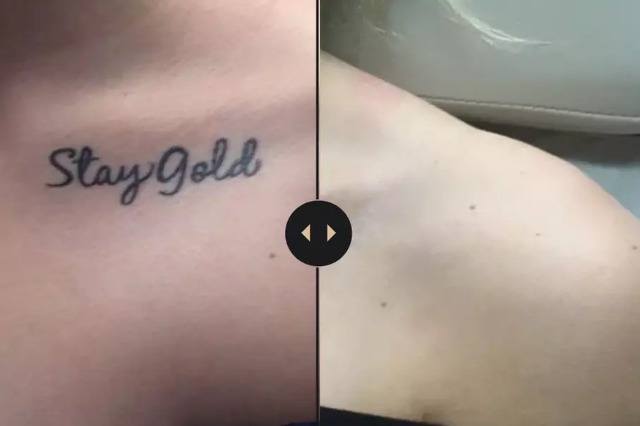 Say Goodbye to Small Tattoos: 1 or 2 Removal Sessions on a Small Area