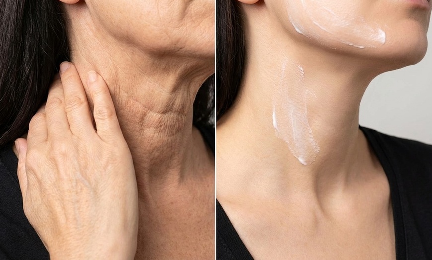 Image 3: Botox Treatments for Forehead, Crow Feet, Lip Flip, or Jawline Areas