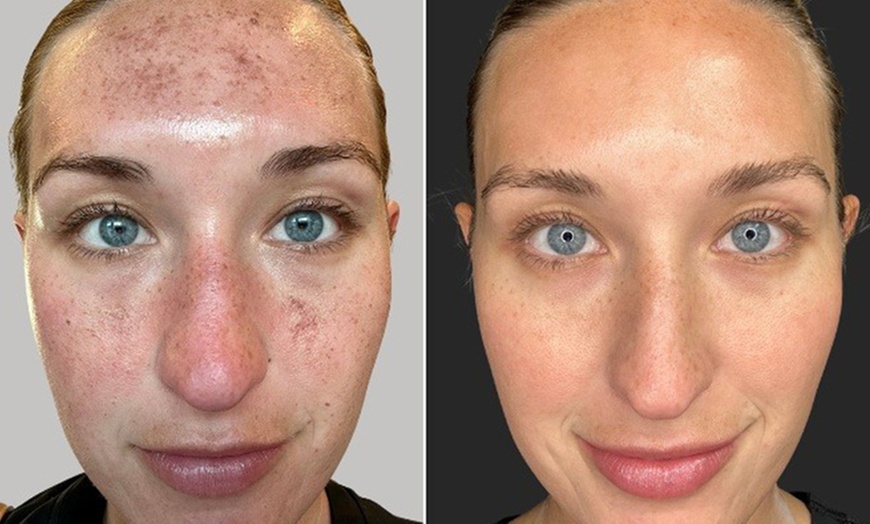 Image 6: Lumecca IPL Session for Full Face, Face and Neck or Face, Neck & Chest