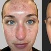 Image 6: Lumecca IPL Session for Full Face, Face and Neck or Face, Neck & Chest