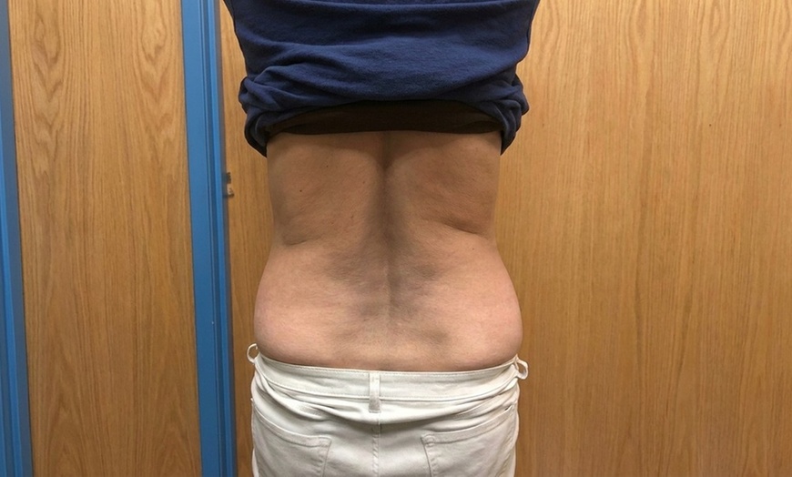 Image 4: Strawberry Laser Lipo Inch Reduction Sessions for Body Contouring