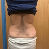 Image 4: Strawberry Laser Lipo Inch Reduction Sessions for Body Contouring