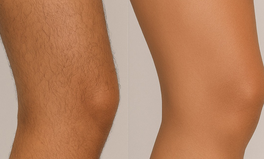 Image 3: 6 Laser Hair Removal Sessions-Small, Medium, Large or Extra Large Area