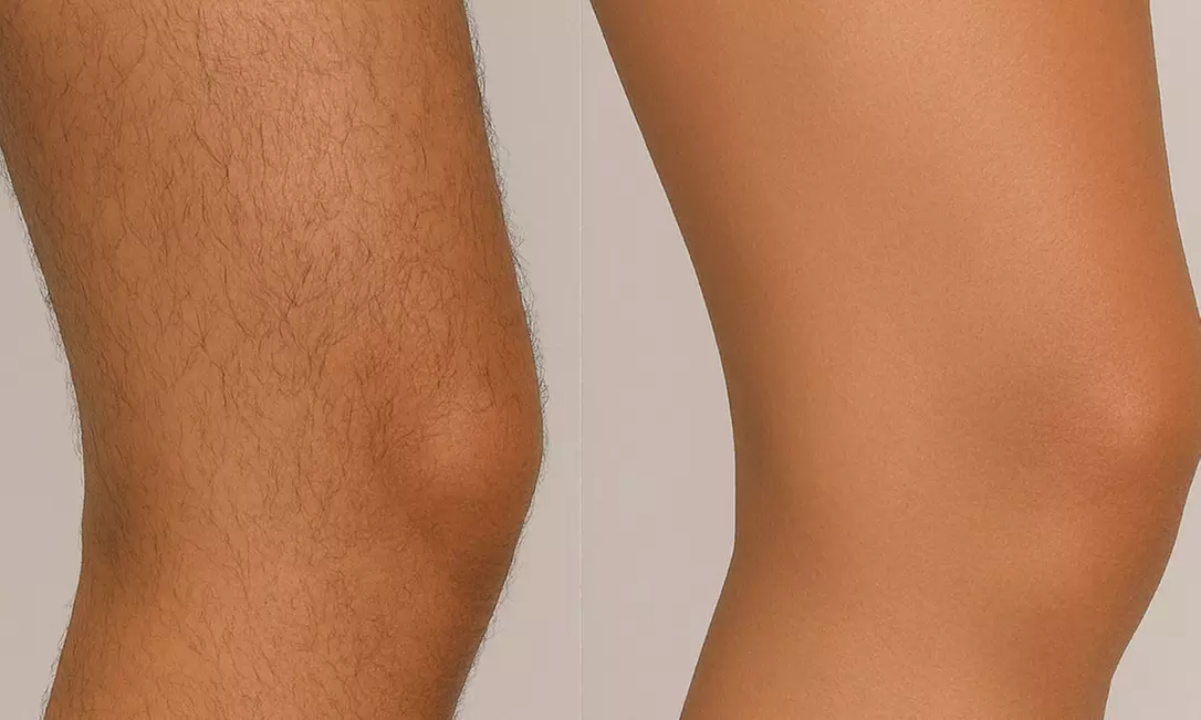 6 Laser Hair Removal Sessions-Small, Medium, Large or Extra Large Area