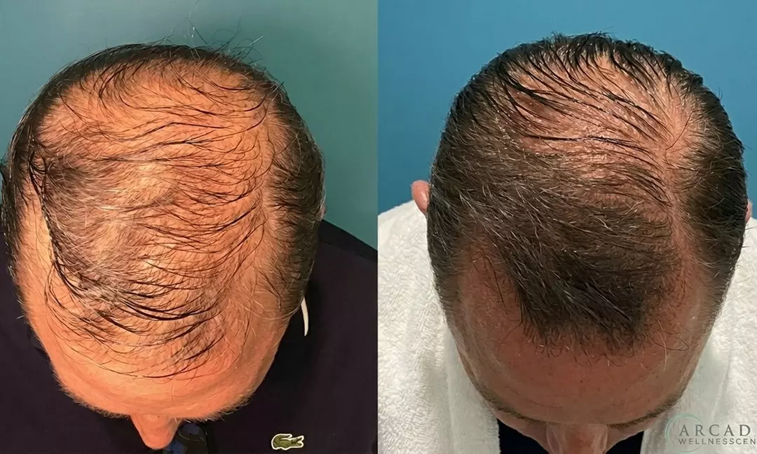 One, Two, Three or Six Sessions Of Medical PRP Hair Restoration