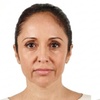 Image 2: Skinvive Hydration & Radiesse Contour Fillers for Radiant Skin