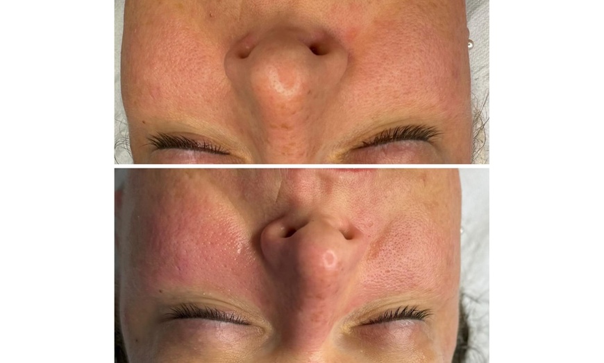 Image 3: Soin Hydrofacial à Villeurbanne : éclat et peau sublimée en 1h20
