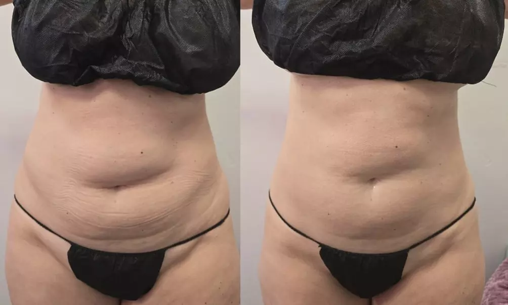 Laser Lipo Sessions With Ultrasound Cavitation Fat Reduction Treatment