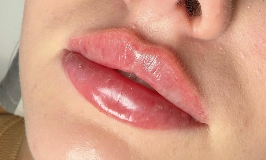 Image 3: Revitalize with 0.5ml, 1ml, or 2ml REVOLAX Dermal Filler+ Consultation