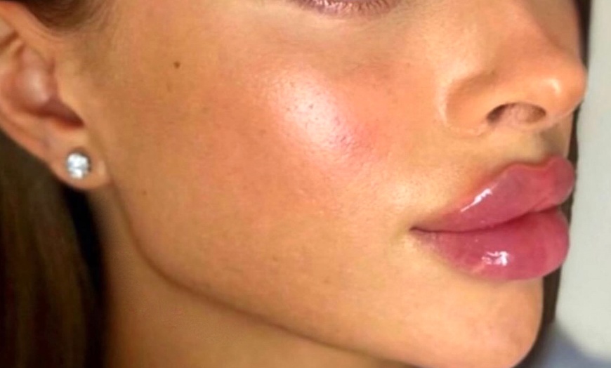 Image 9: Revanesse Versa Dermal Filler: Natural Lip & Facial Enhancement