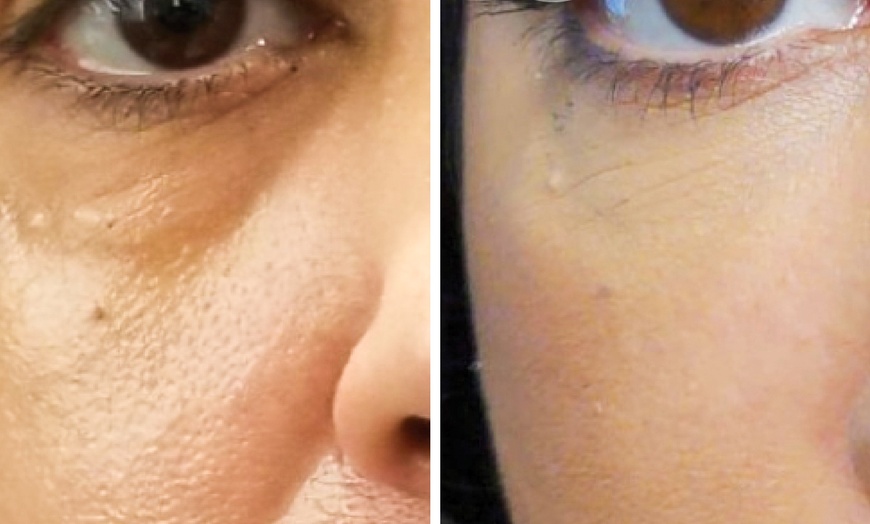 Image 3: Experience Youthful Eyes with One session EZ GEL PRF for Under Eyes