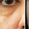 Image 3: Experience Youthful Eyes with One session EZ GEL PRF for Under Eyes
