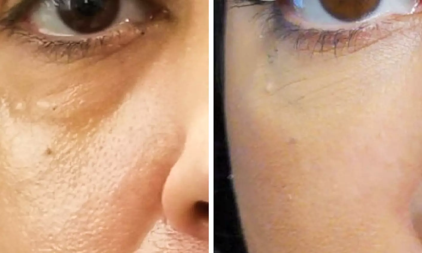 Experience Youthful Eyes with One session EZ GEL PRF for Under Eyes