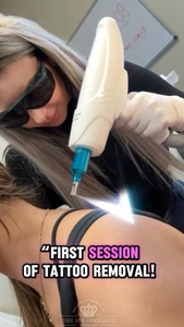Three Laser Tatto Removal Sessions on a Small area - The Spa Associate