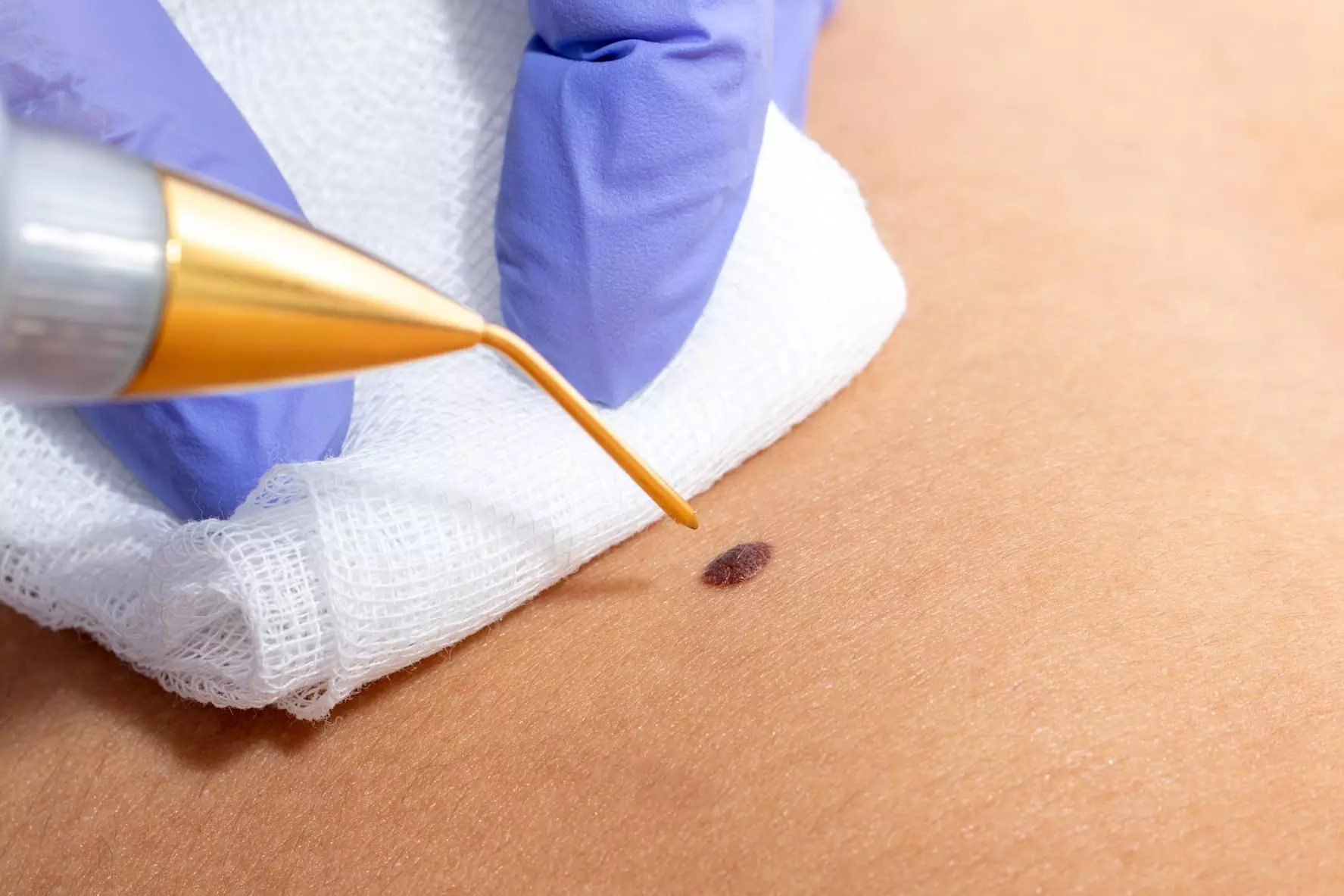 Discover The Fibroblast Parlor's Jet Plasma, Lip Flip, and More with up to 55% Discount - Second Medium