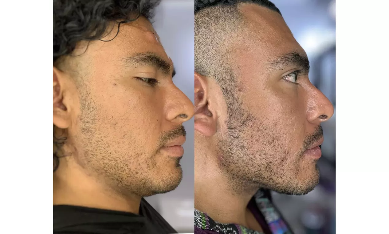 Tone with Five Sessions of Body Sculpting - Small or Large Area