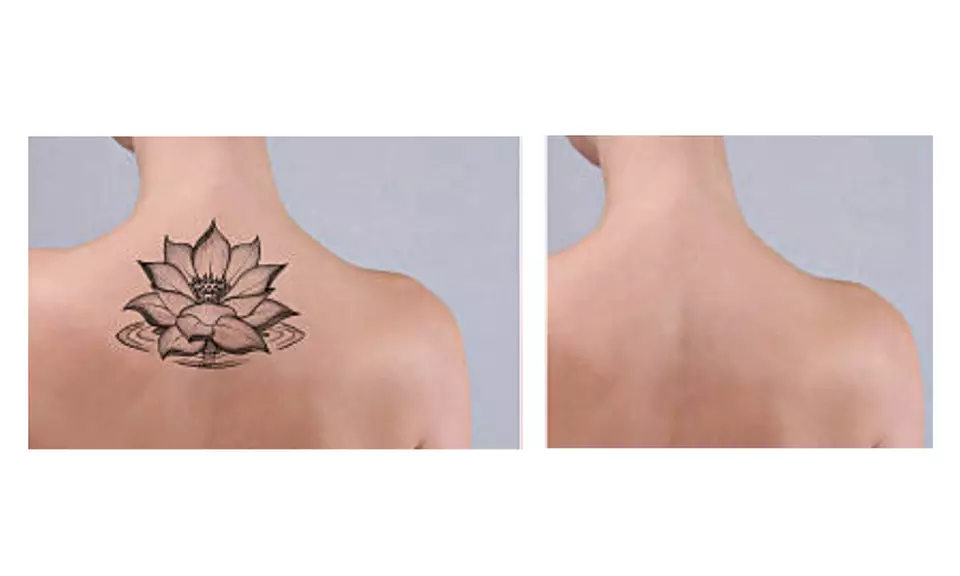 Tattoo Removal-Any Area, Skin Camouflage, or Eyebrow Tattoo Removal at Flashback Skin Camouflage (Up to 49% Off) - Image 3