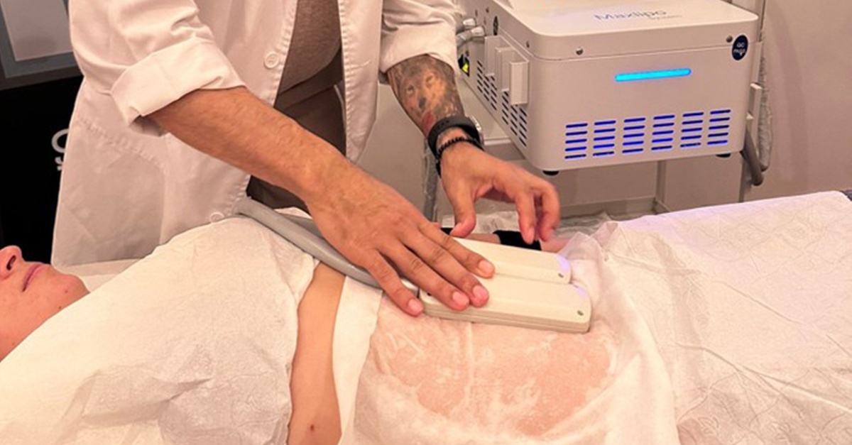 Tratamiento de criolipólisis y EMSculpt en Barcelona