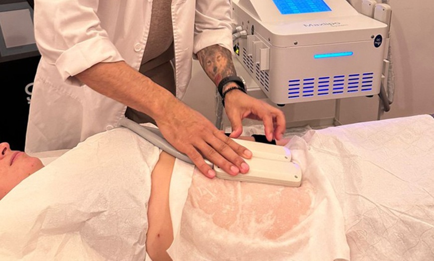 Image 1: Reduce la grasa con hasta 2 sesiones de criolipólisis y EMSculpt