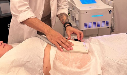 1 sesión de criolipólisis con EMSculpt de 30 minutos - KG Clínica y Salud