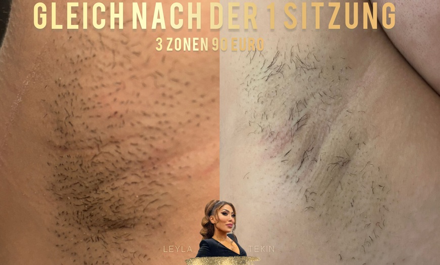 Image 3: 3 oder 6 Sitzungen mit Laserhaarentfernung an 1 kleinen / großen Zone