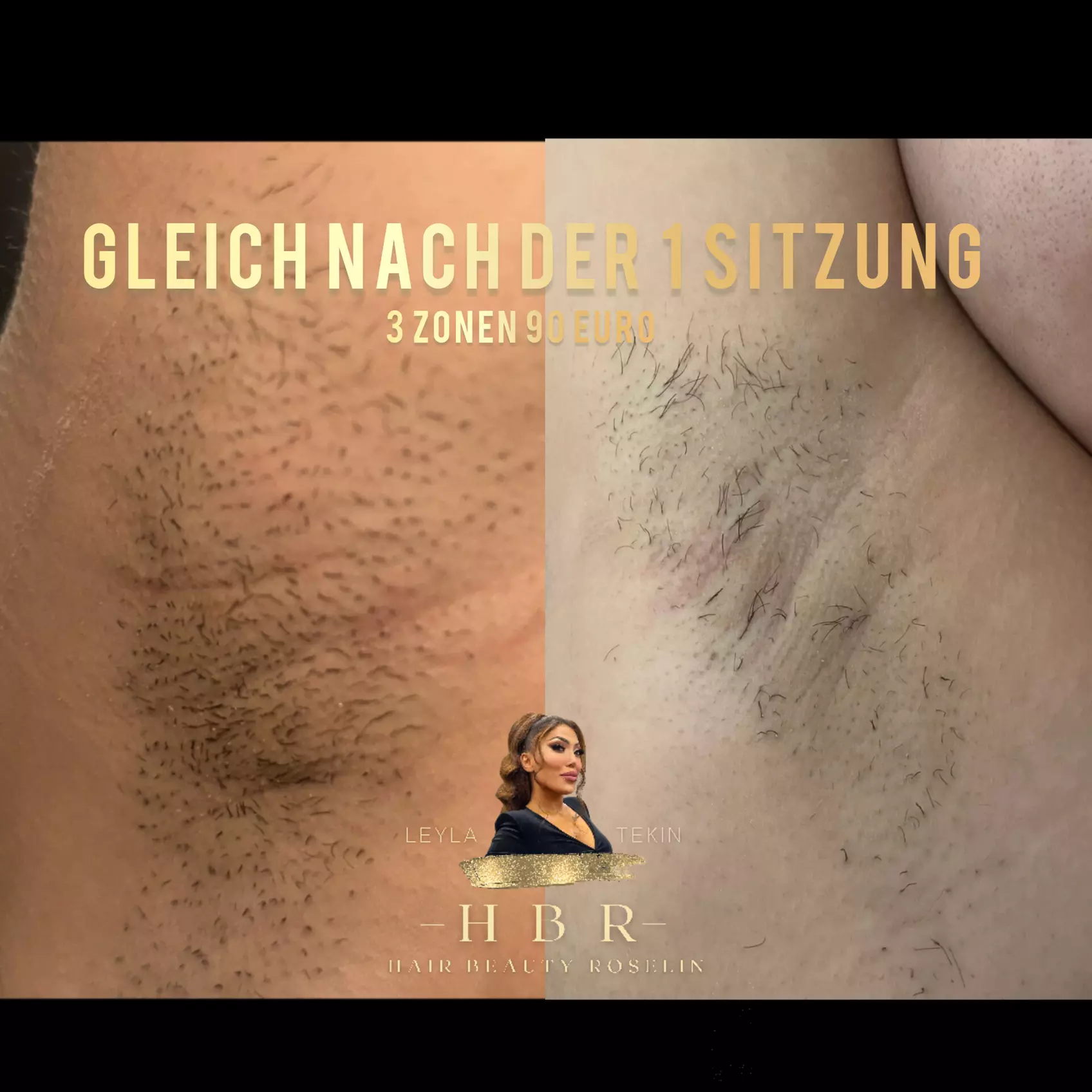 3 oder 6 Sitzungen mit Laserhaarentfernung an 1 kleinen / großen Zone