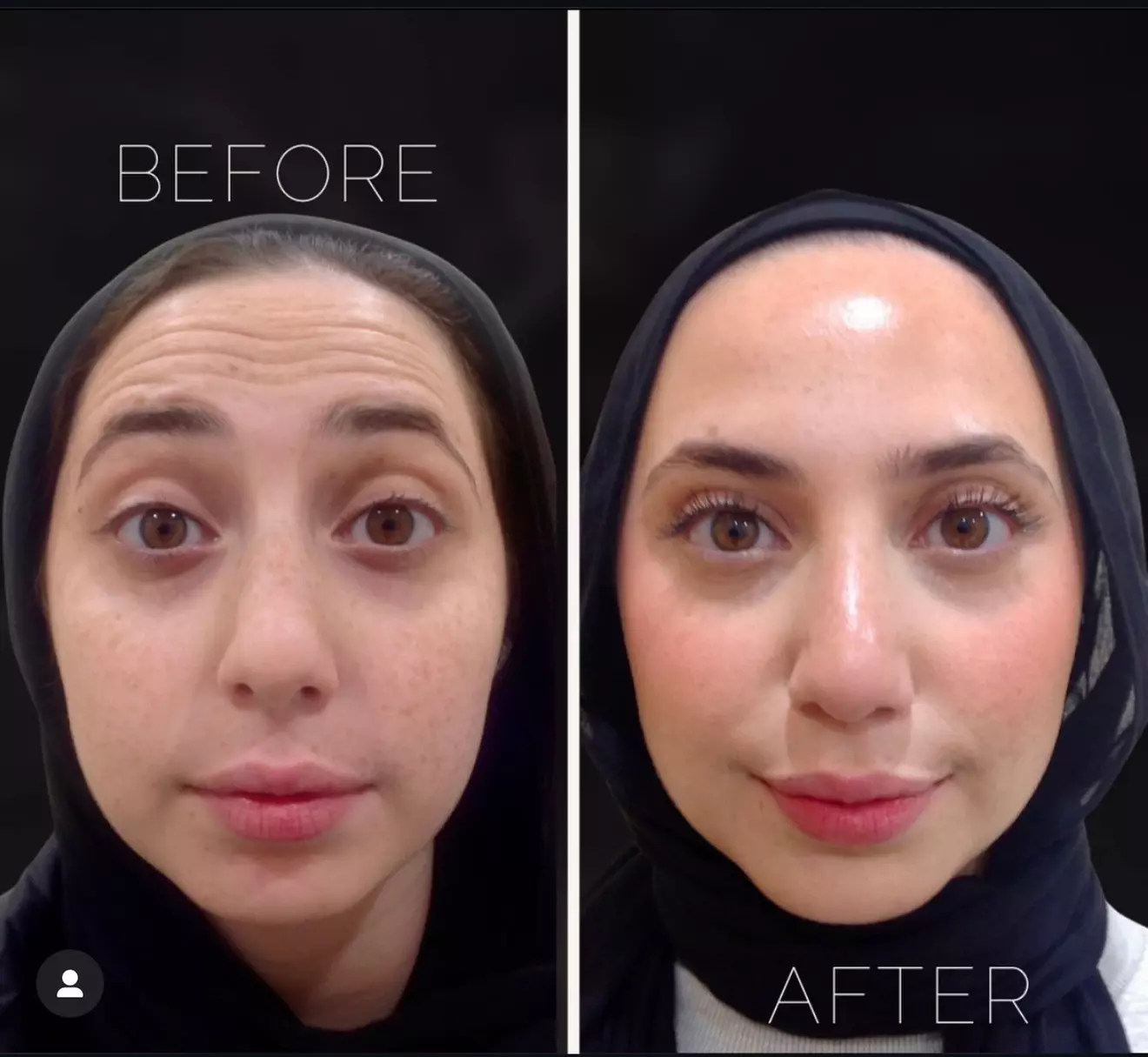 BOTOX® at Chicago Institute of Plastic Surgery