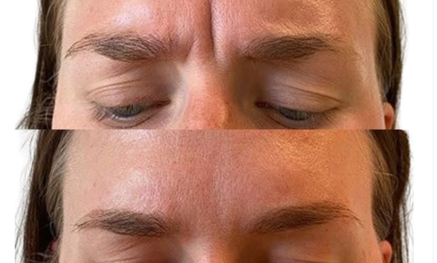 Image 3: Botox Units for Forehead Lines Crow Feet and Full Face Smoothing