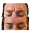 Image 3: Botox Units for Forehead Lines Crow Feet and Full Face Smoothing
