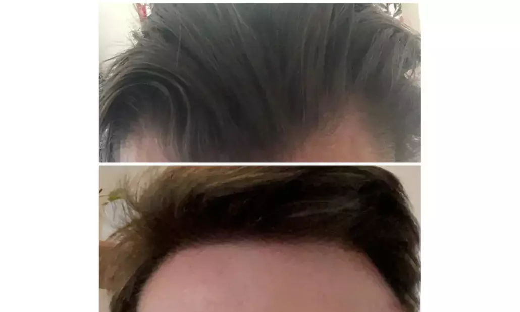 Natural-Looking Hair Restoration with Up to 3000-Graft FUE Transplant