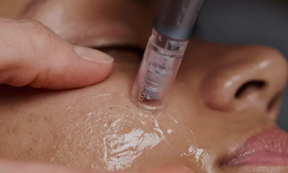 Achieve Deep Renewal with One, Three or Five Chemical Peel Sessions