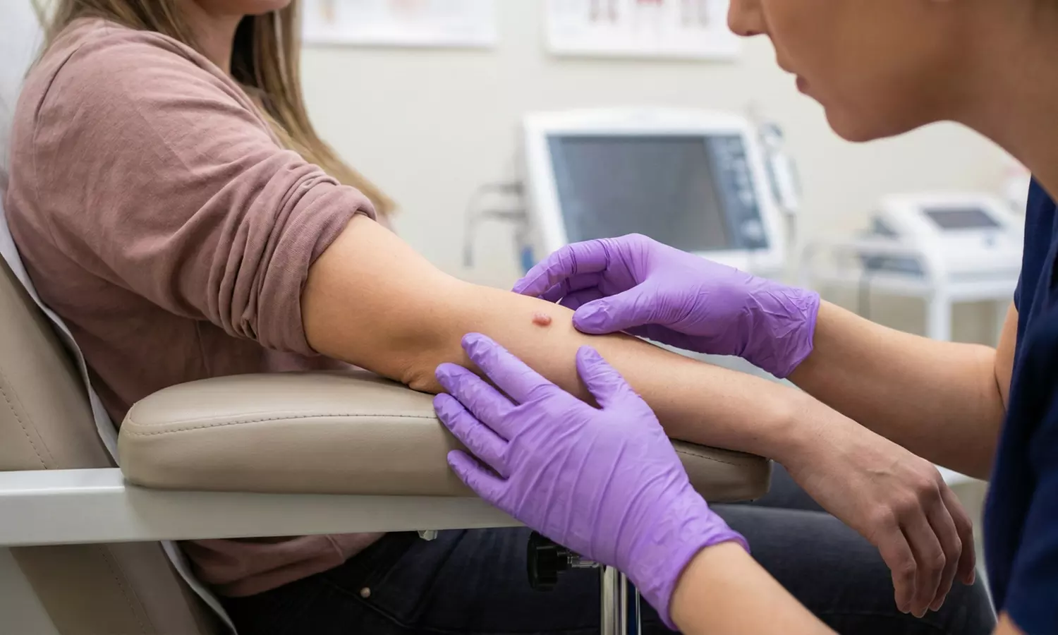 Tratamiento láser para eliminar verrugas, lunares o queratosis