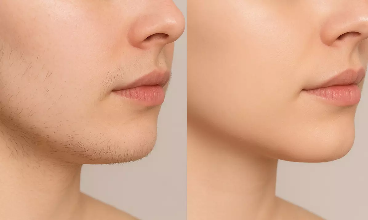 6 Laser Hair Removal Sessions-Small, Medium, Large or Extra Large Area