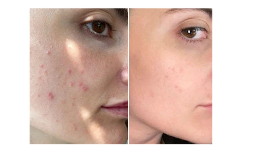 Image 2: Blackhead Removal or Blemish Treatment Facial or Molecular Peeling