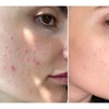 Image 2: Blackhead Removal or Blemish Treatment Facial or Molecular Peeling