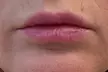 Lip Flip or 20–40 Xeomin Units for Smoother Skin & Fuller Lips at Slim Fit Beauty Up To  59% Off - Second Medium