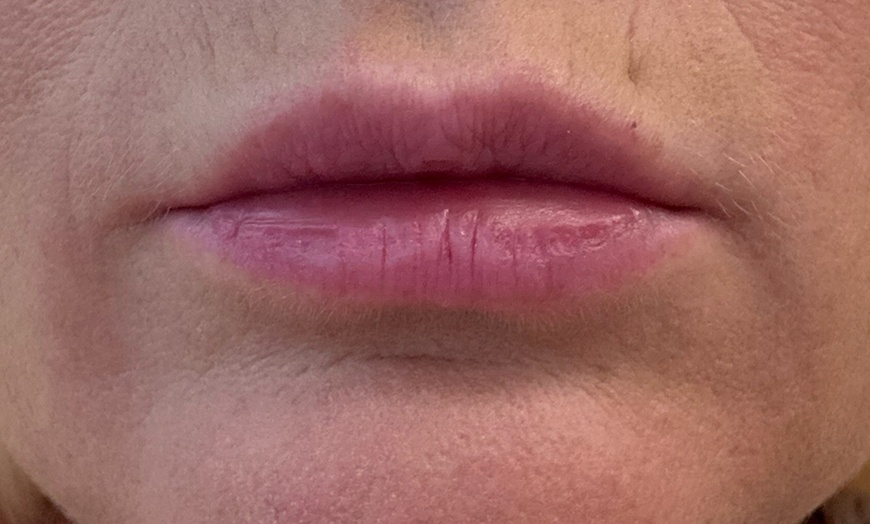 Image 4: Lip Flip or 20–40 Units of Xeomin for a Smooth, Youthful Look 