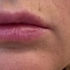 Image 4: Lip Flip or 20–40 Units of Xeomin for a Smooth, Youthful Look 