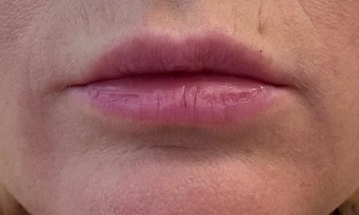 Lip Flip or 20–40 Units of Xeomin for a Smooth, Youthful Look