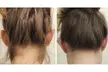 A-ONE Laser Clinic: Three Laser Hair Removal Sessions for Small, Medium or Large Area (Up To 75% Off) - Second Medium