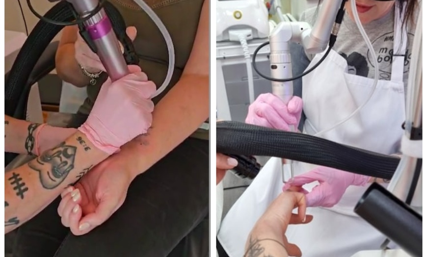 Image 4: Up to 60% Off on Tattoo Removal at Hot Mess