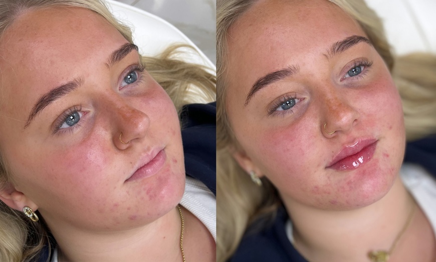 Image 1: Up to 75% off Signature Dermal Filler for Lips & Face - 1ml up to 2ml
