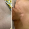 Image 3: Remove Up To 10 Skin Tags, Moles, Warts Or Milia Up To 2mm
