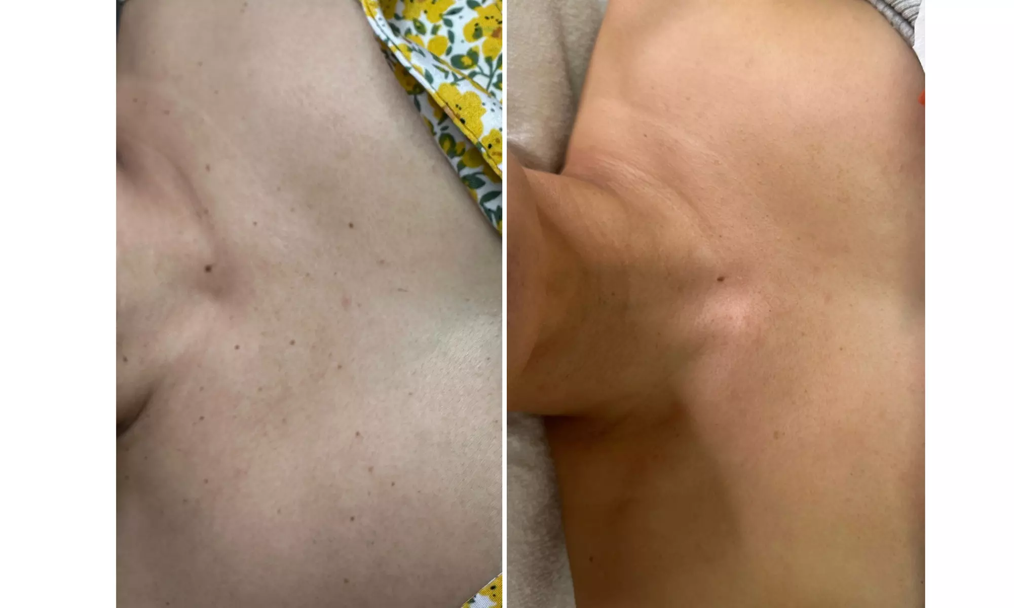 Remove Up To 10 Skin Tags, Moles, Warts Or Milia Up To 2mm