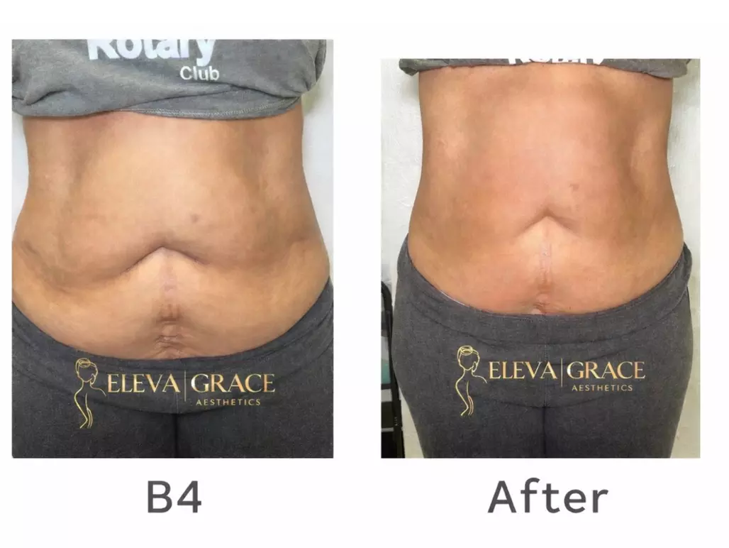 Up to 94% off on Laser Lipo and Ultrasonic Cavitation Treatments