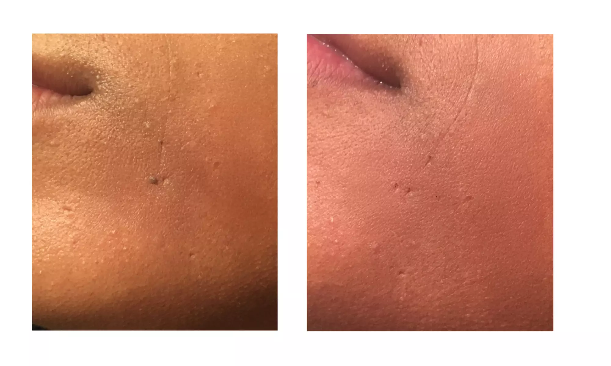 Discover Skin Care New York's effective skin tag, mole, and spot removal with laser tech, offering up to 50% off. - Second Medium